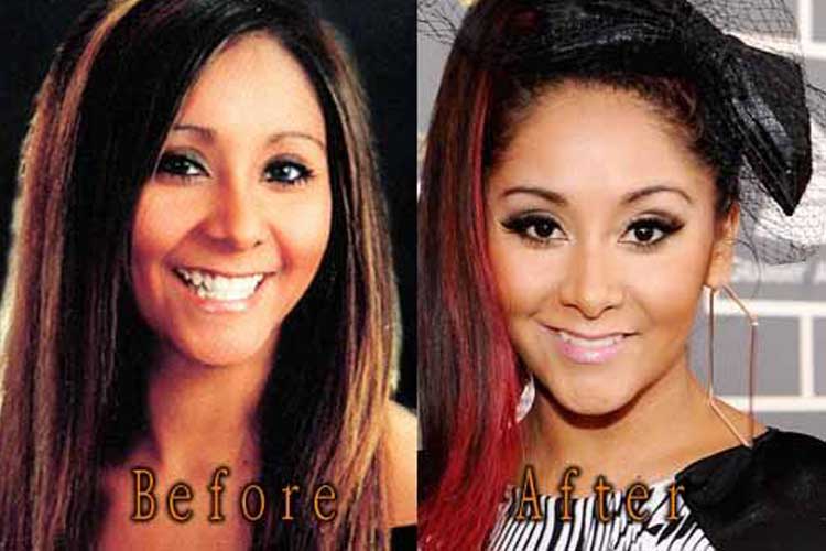 Snooki Plastic Surgery