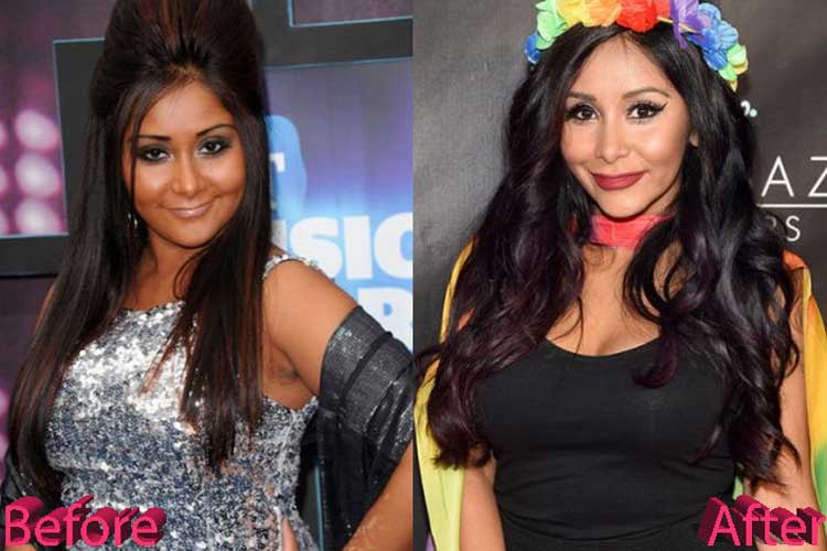 Snooki Plastic Surgery