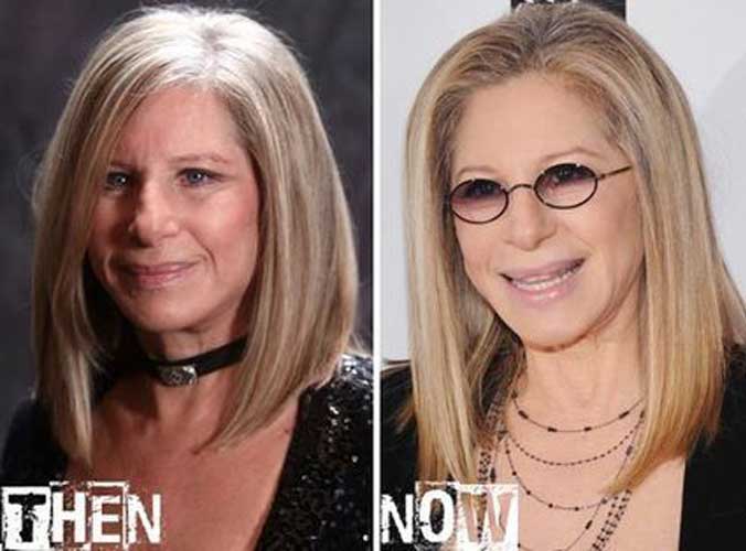 Barbra Streisand plastic surgery