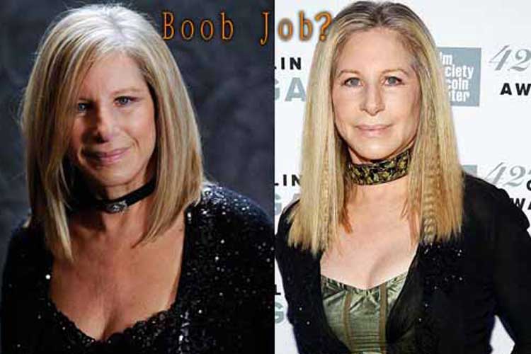 Barbra Streisand plastic surgery