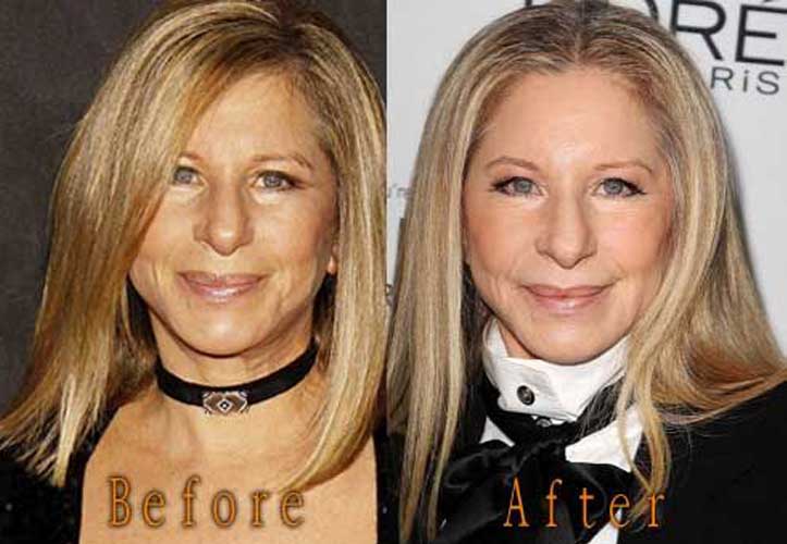 Barbra Streisand plastic surgery