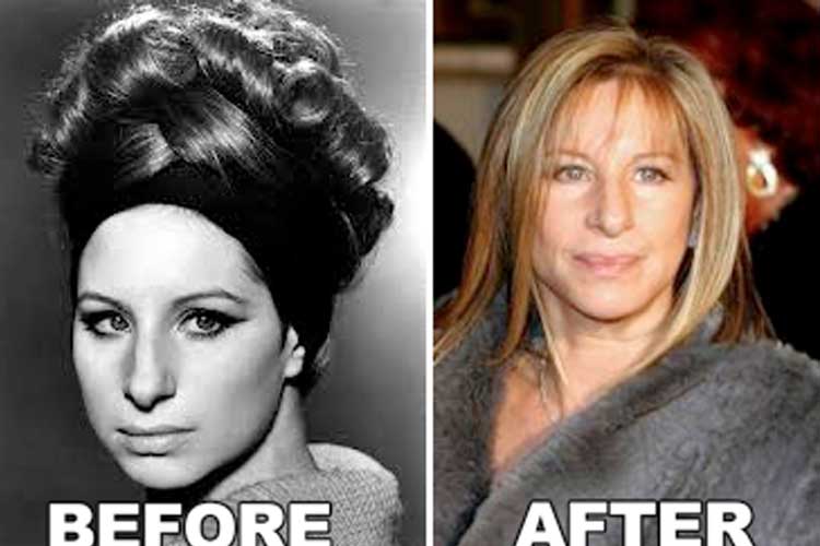 Barbra Streisand plastic surgery