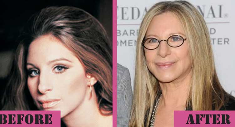 Barbra Streisand plastic surgery