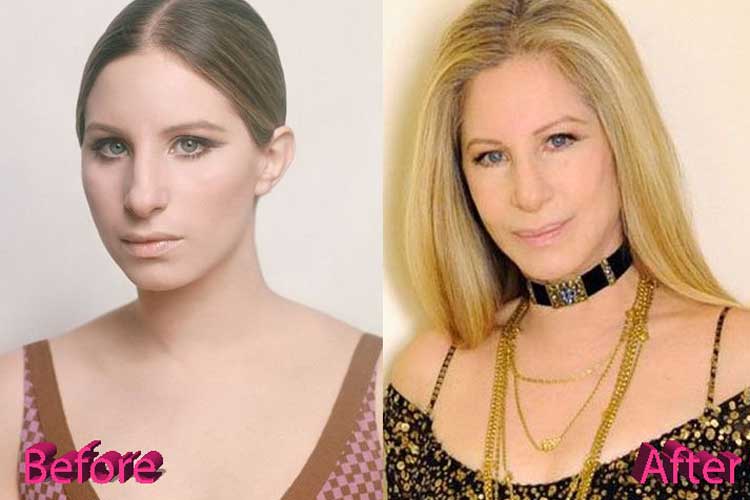 Barbra Streisand plastic surgery