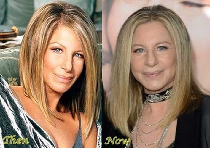 Barbra Streisand plastic surgery