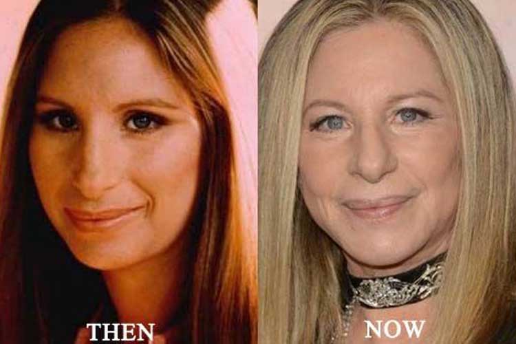 Barbra Streisand plastic surgery