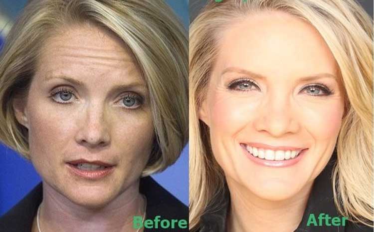 Dana Perino plastic surgery