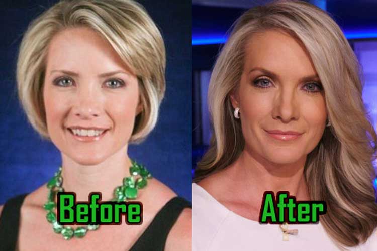 Dana Perino plastic surgery