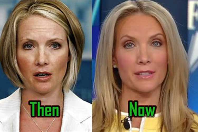 Dana Perino plastic surgery