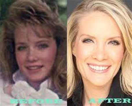 Dana Perino plastic surgery