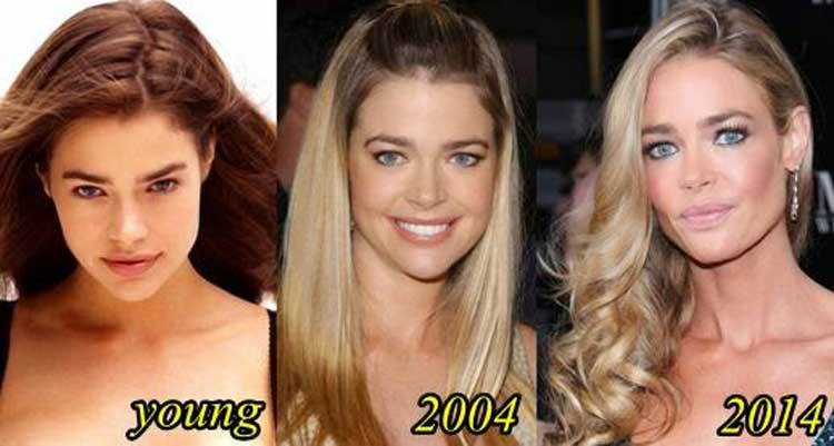 Denise Richards plastic surgery