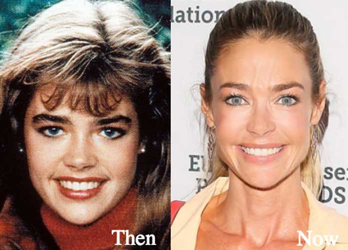 Denise Richards plastic surgery