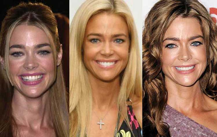 Denise Richards Plastic Surgery Breast Augmentation Botox Lip Filler