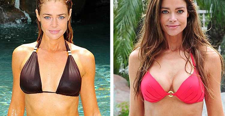 Denise Richards plastic surgery