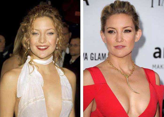 Kate Hudson Plastic Surgery