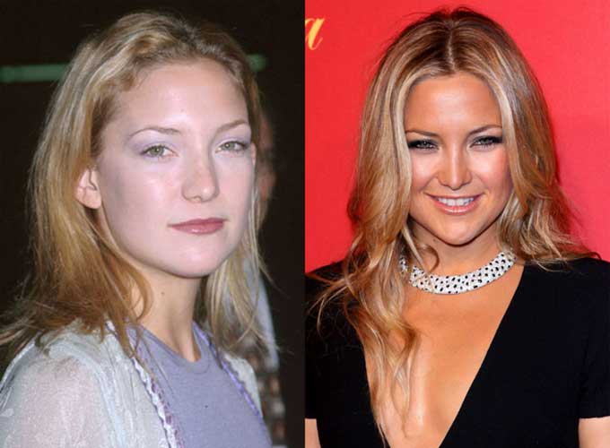 Kate Hudson Plastic Surgery