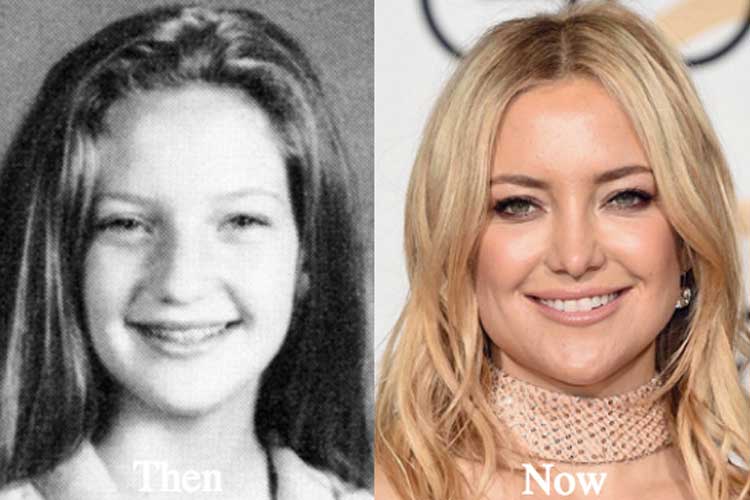 Kate Hudson Plastic Surgery