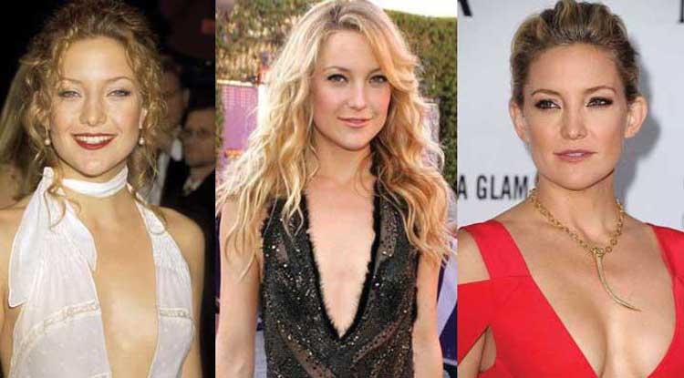 Kate Hudson Plastic Surgery