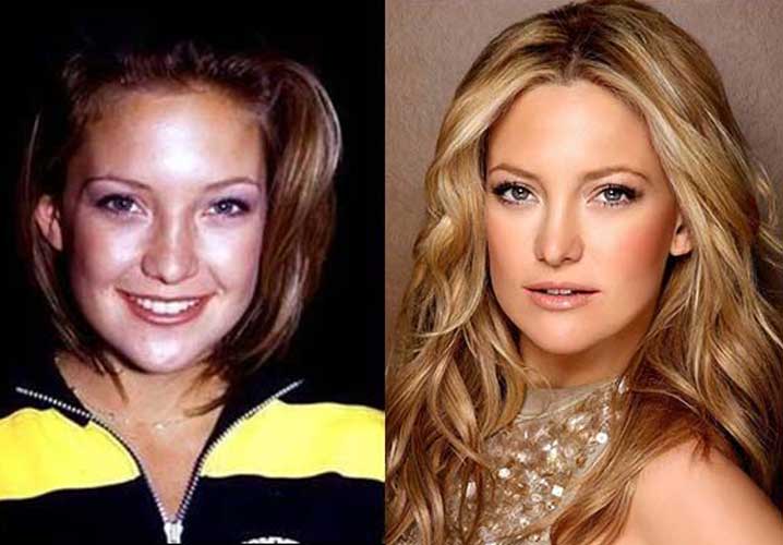 Kate Hudson Plastic Surgery