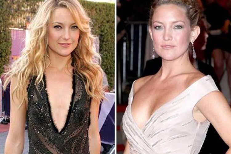 Kate Hudson Plastic Surgery