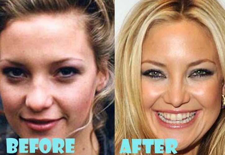 Kate Hudson Plastic Surgery