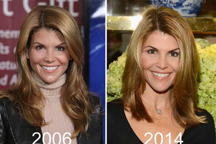 Lori Loughlin plastic surgery