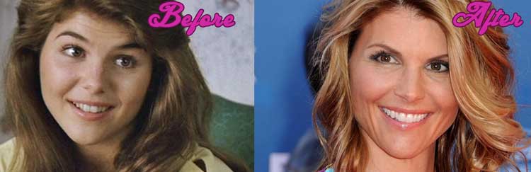 Lori Loughlin plastic surgery