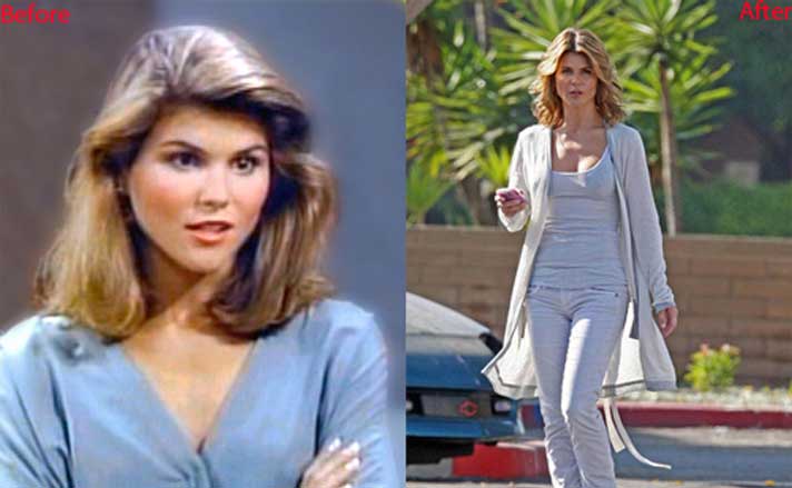 Lori Loughlin plastic surgery