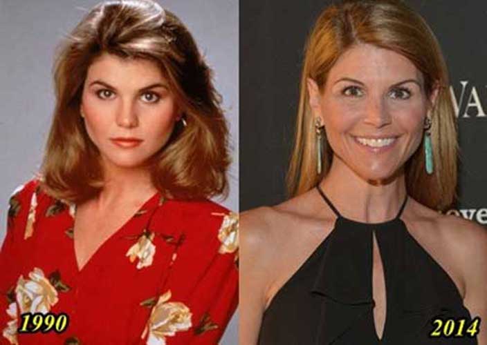 Lori Loughlin plastic surgery