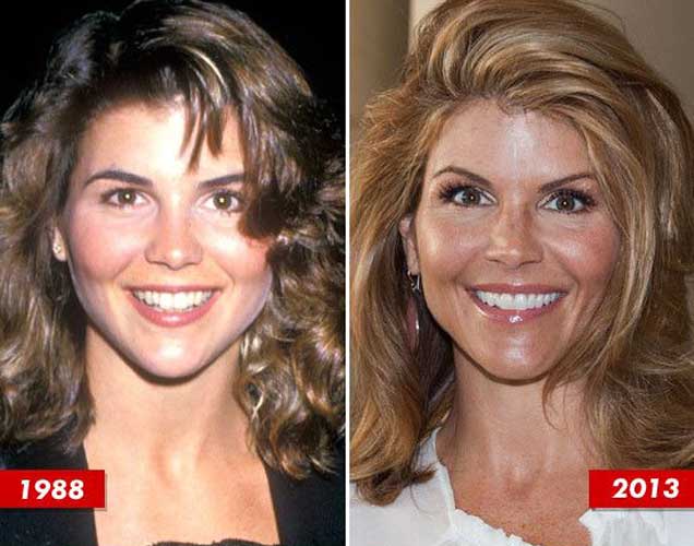 Lori Loughlin plastic surgery