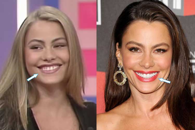 Sofia Vergara plastic surgery 