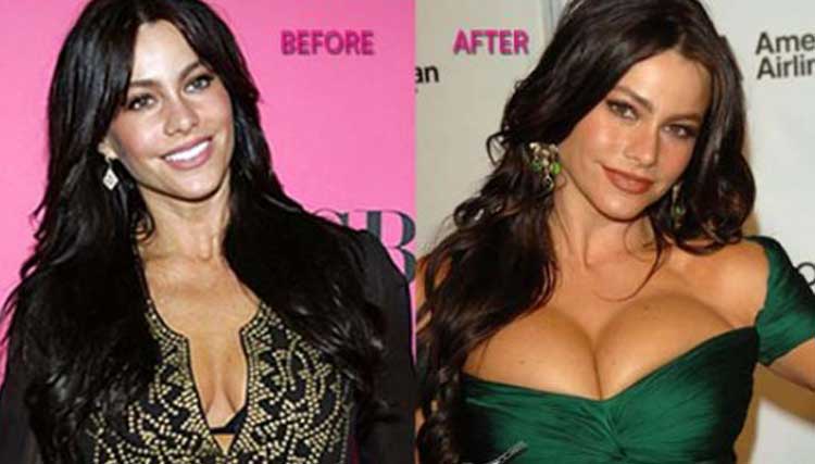 Sofia Vergara plastic surgery 