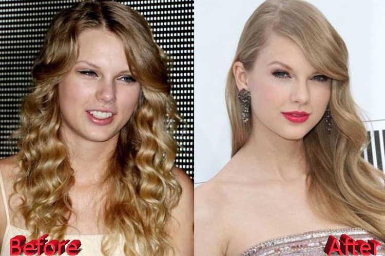 Taylor Swift plastic surgery