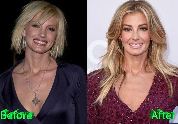 Faith Hill Plastic Surgery