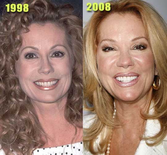 Kathie Lee Gifford plastic surgery