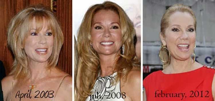 Kathie Lee Gifford plastic surgery