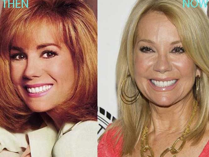 Kathie Lee Gifford plastic surgery