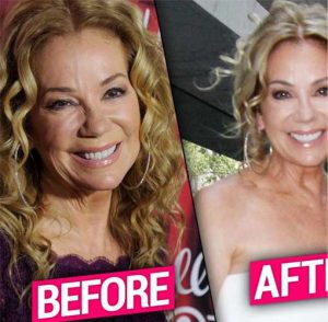 Kathie Lee Gifford Plastic Surgery: Cheek Filler, Nose Job, Botox