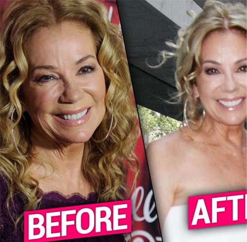 Kathie Lee Gifford plastic surgery