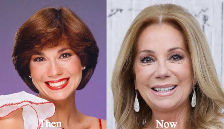 Kathie Lee Gifford plastic surgery