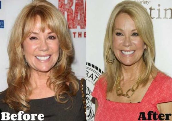 Kathie Lee Gifford Plastic Surgery: Cheek Filler, Nose job, Botox