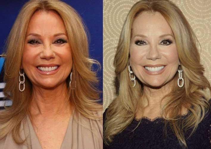 Kathie Lee Gifford plastic surgery