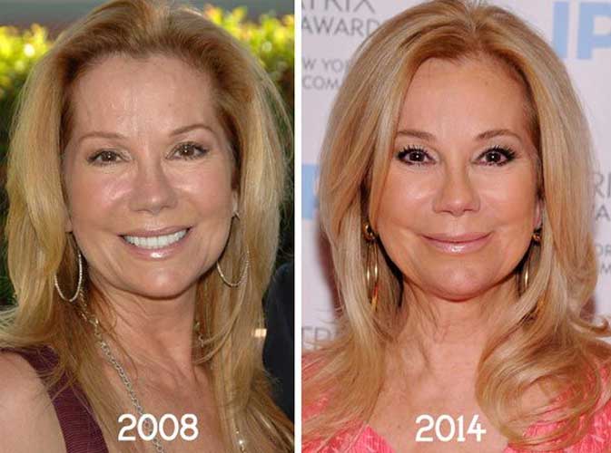 Kathie Lee Gifford plastic surgery