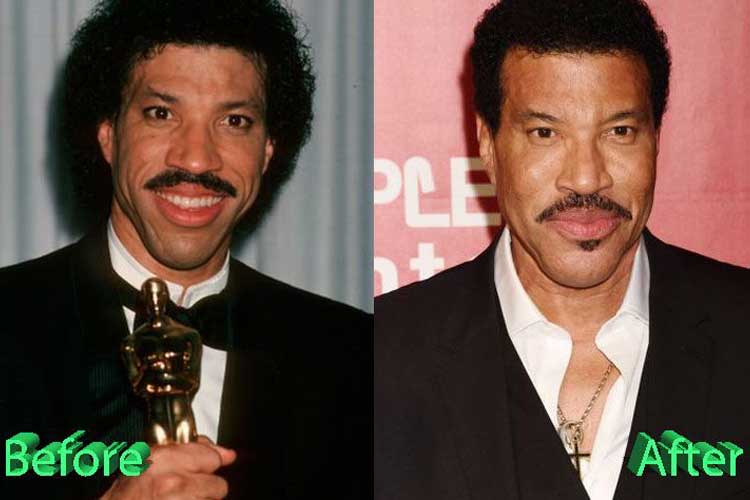 Lionel Richie Plastic Surgery