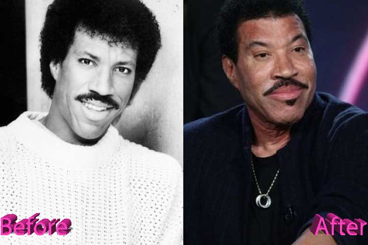 Lionel Richie Plastic Surgery