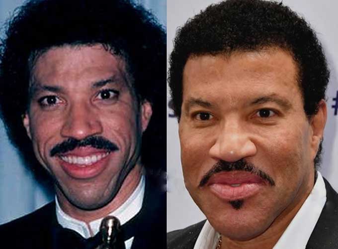 Lionel Richie Plastic Surgery