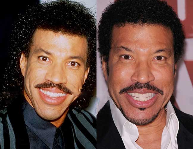 Lionel Richie Plastic Surgery