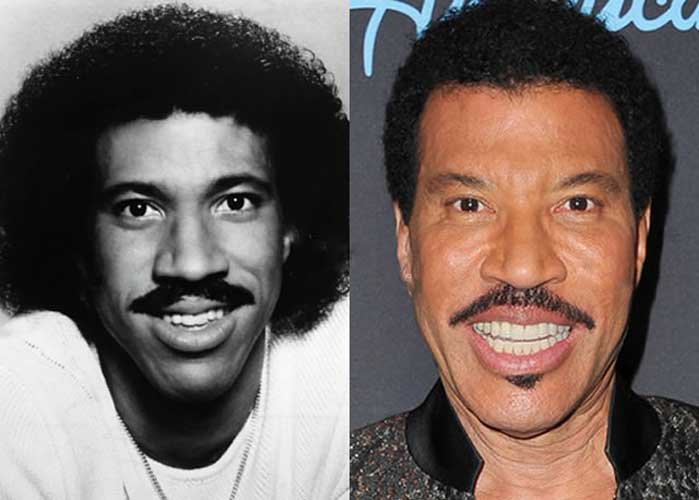 Lionel Richie Plastic Surgery