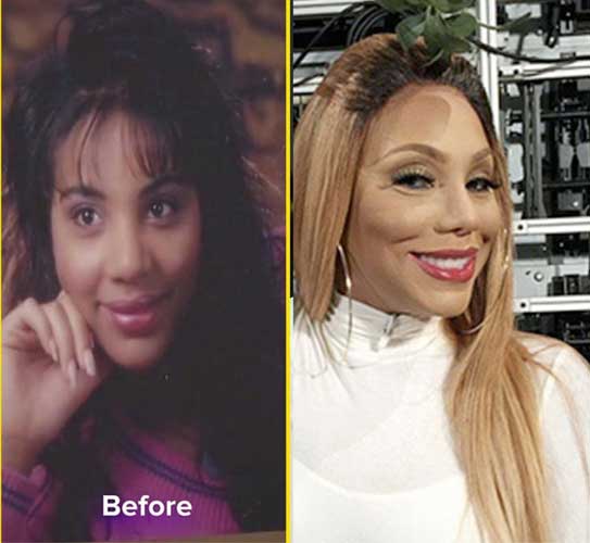 Tamar Braxton plastic surgery