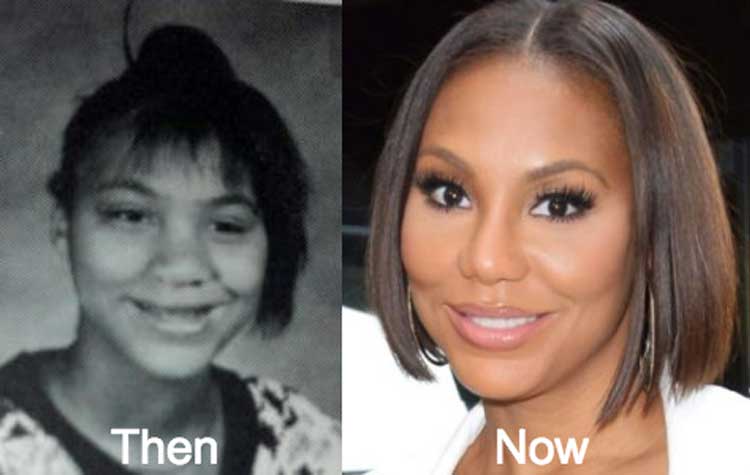 Tamar Braxton plastic surgery